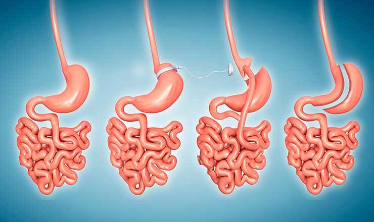Obezite Cerrrahisi Merkezi