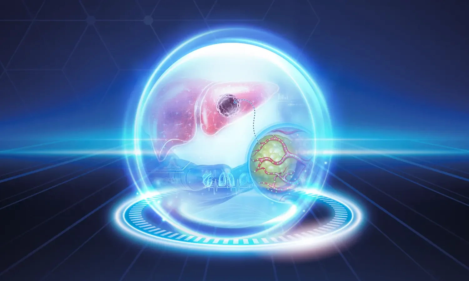 Y90 Mikroküre Tedavisi