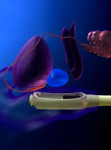 Non-Surgical Prostate Cancer Treatment with Robotic HIFU