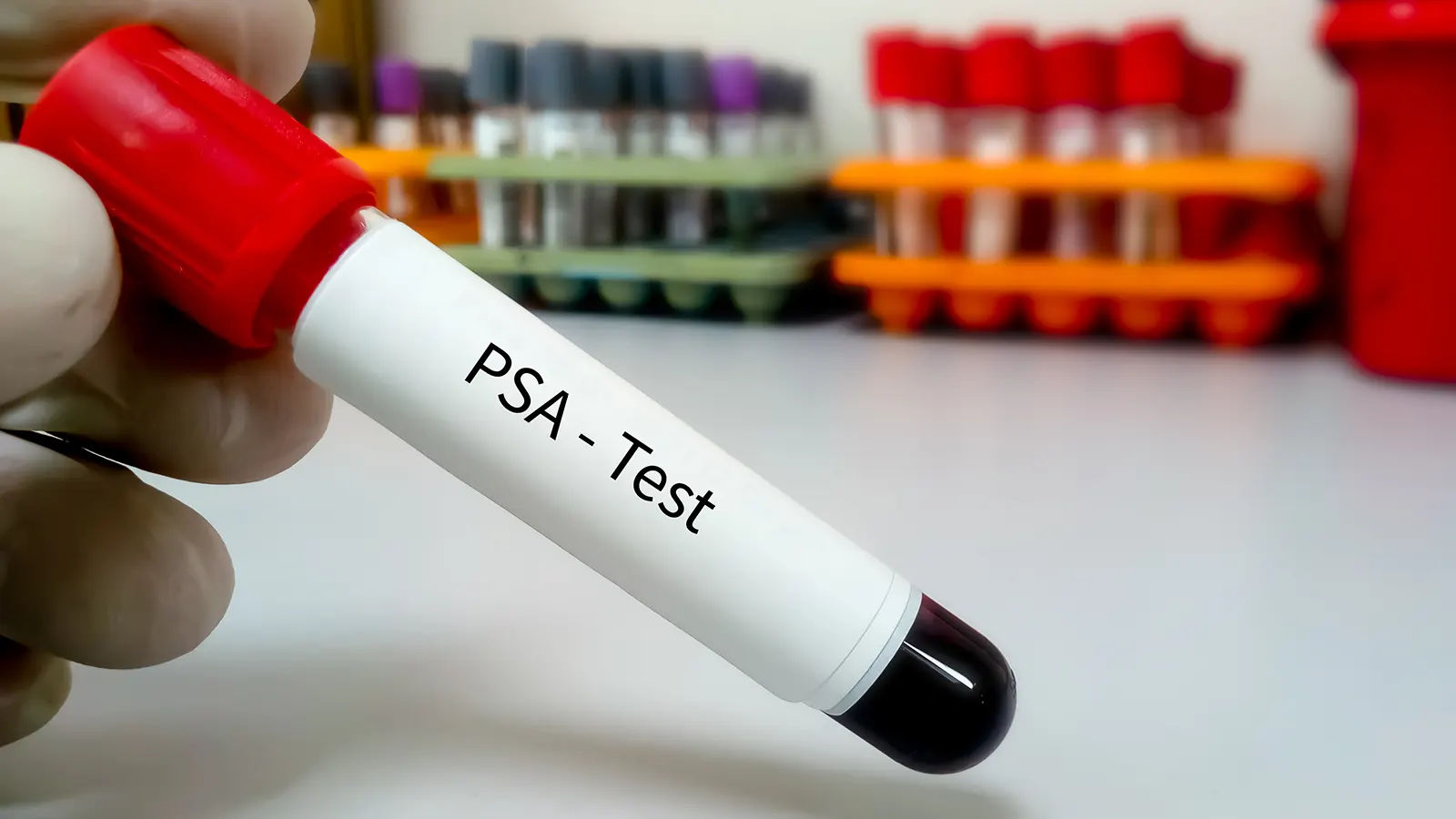 PSA Testi Nedir? Prostat Kanseri ve Prostat Sağlığı İçin Önemi