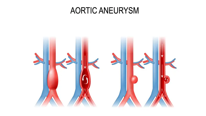 What is an Aortic Aneurysm?