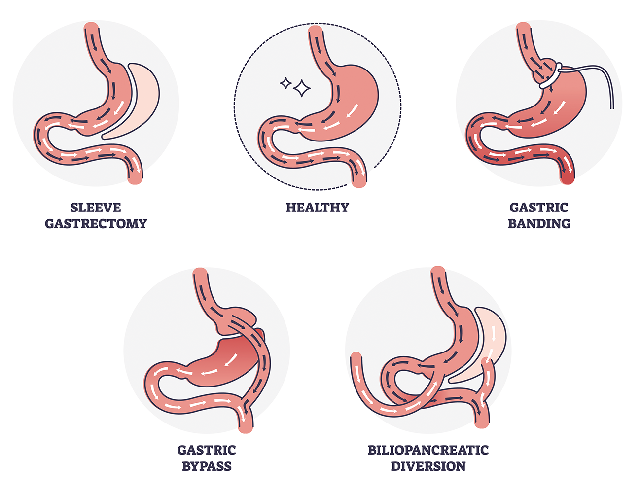 gastrik-bypass-ameliyati-nedir