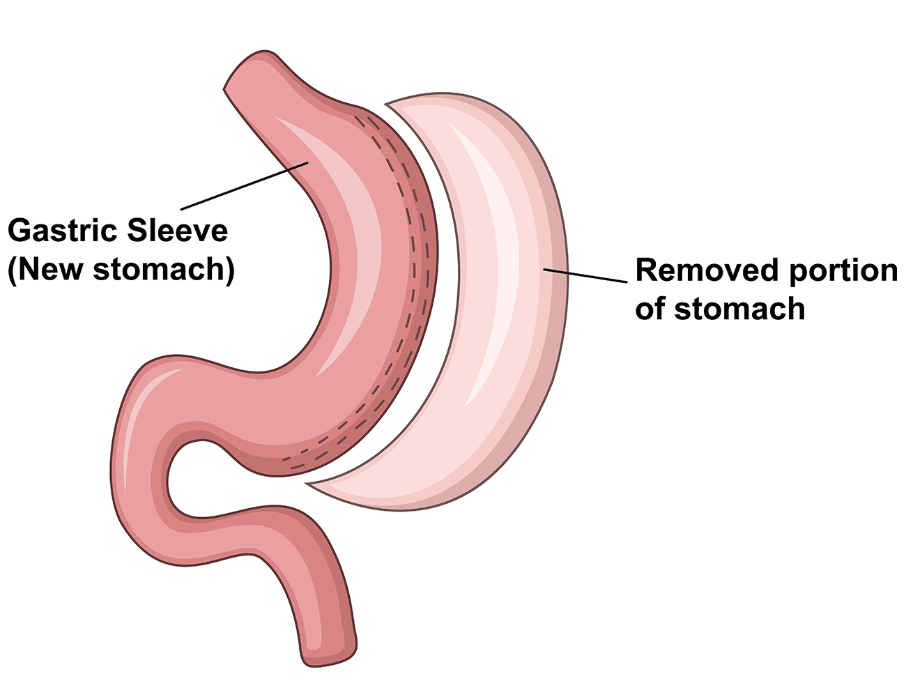 sleeve-gastrektomi-tup-mide-ameliyati-nedir